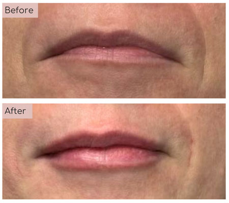 lip fillers before and afters